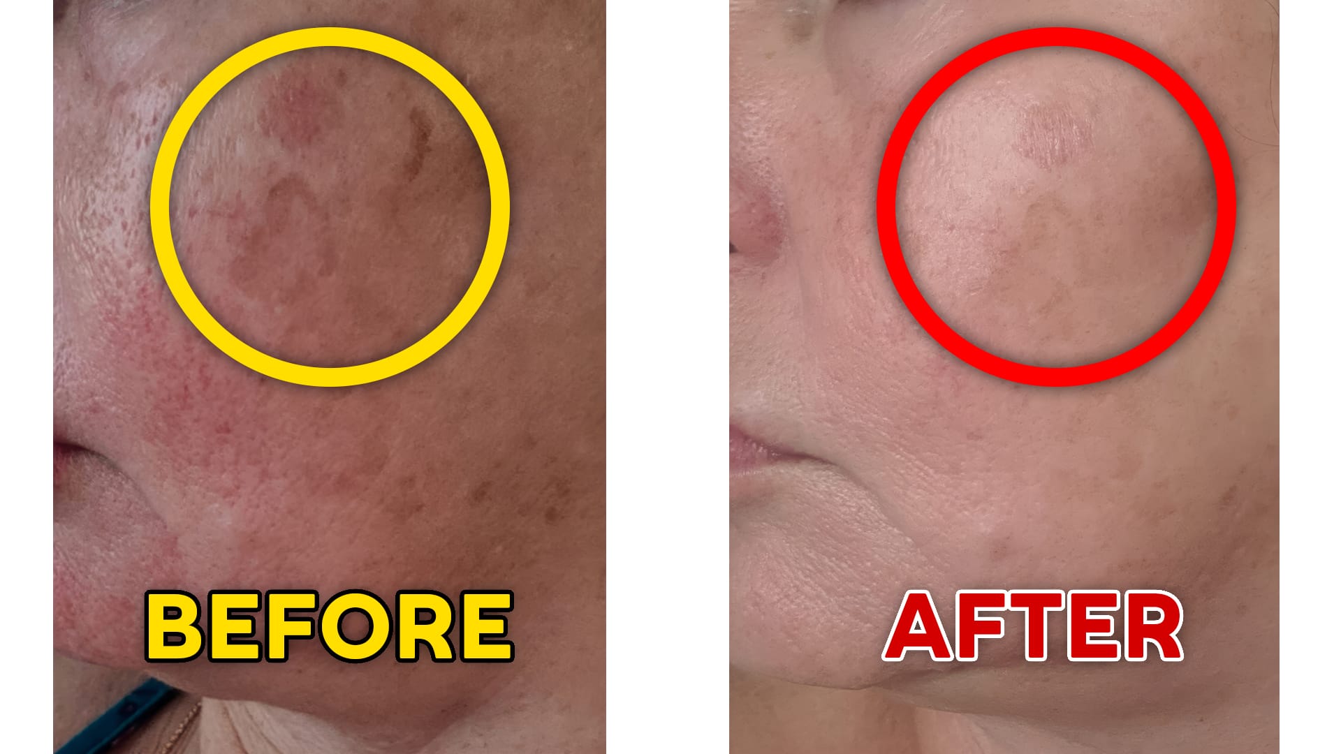 Red Light Therapy For Face Before And After: Unbelievable Results!